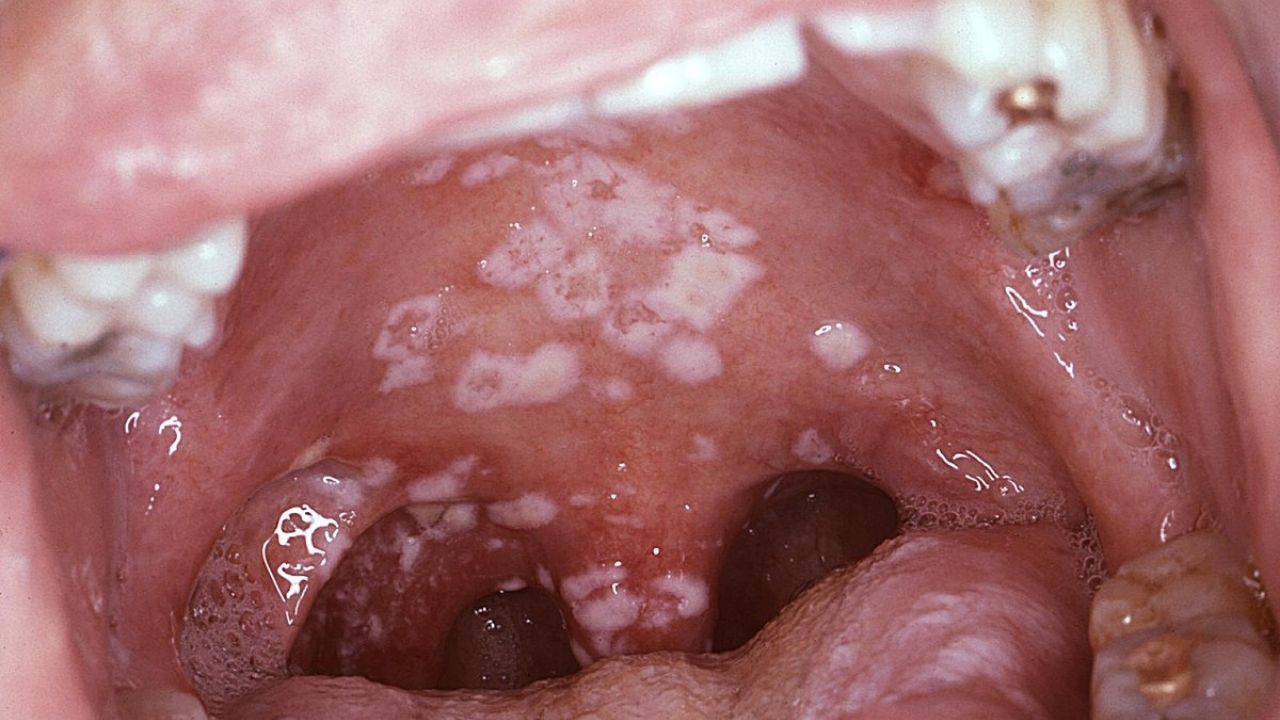 Candida Mantarı Nedir Ve Enfeksiyonlardan Nasıl Korunulur - Yazar Kadın