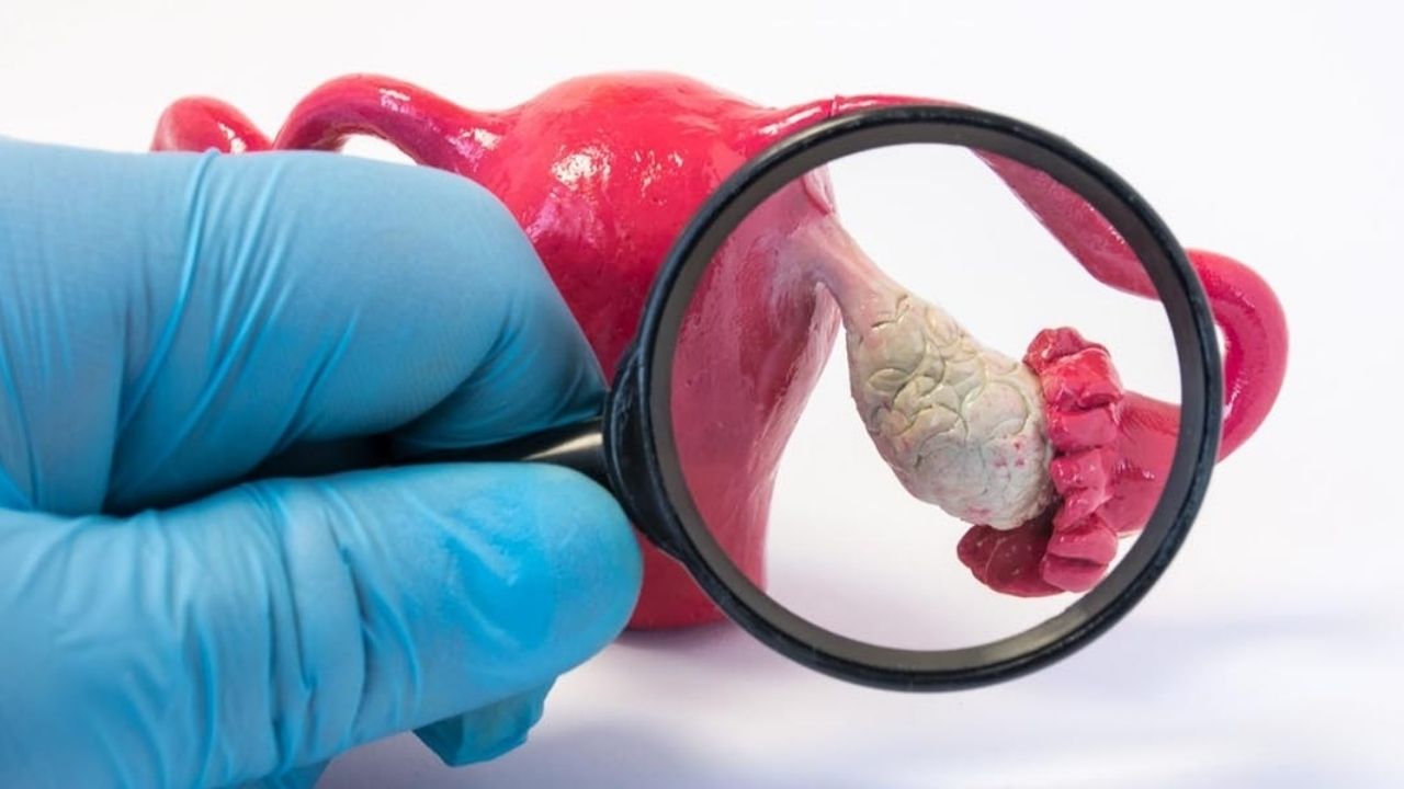 Çikolata Kisti (endometrioma) Nedir Belirtileri Ve Tedavi Yöntemleri - Yazar Kadın