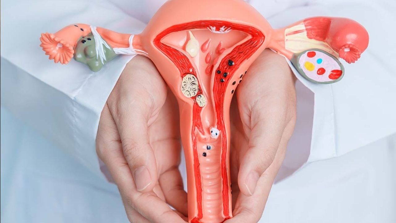 Endometriozis Nedir Belirtileri, Nedenleri Ve Tedavi Yöntemleri - Yazar Kadın