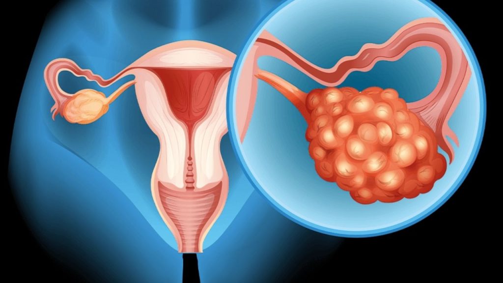 Polikistik Over Sendromu (pcos) Belirtileri Ve Tedavi Yolları - Yazar Kadın