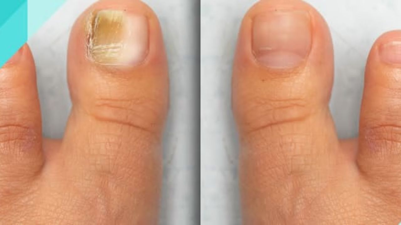 Tırnak Mantarı Nedir Belirtileri Ve Tedavi Yöntemleri Nelerdir - Yazar Kadın