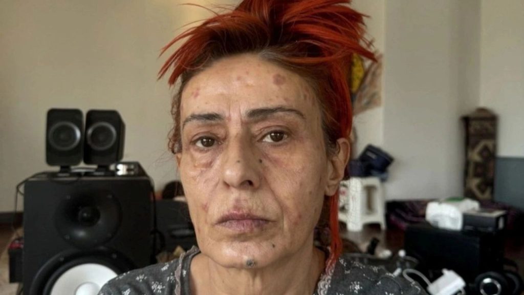 Yıldız Tilbe, Saç Boyasının Ardından Yüzündeki Yanıkları Açıkladı - Yazar Kadın