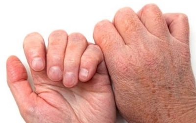 Kuru Ciltler: Nedenleri, Belirtileri ve Tedavi Yöntemleri