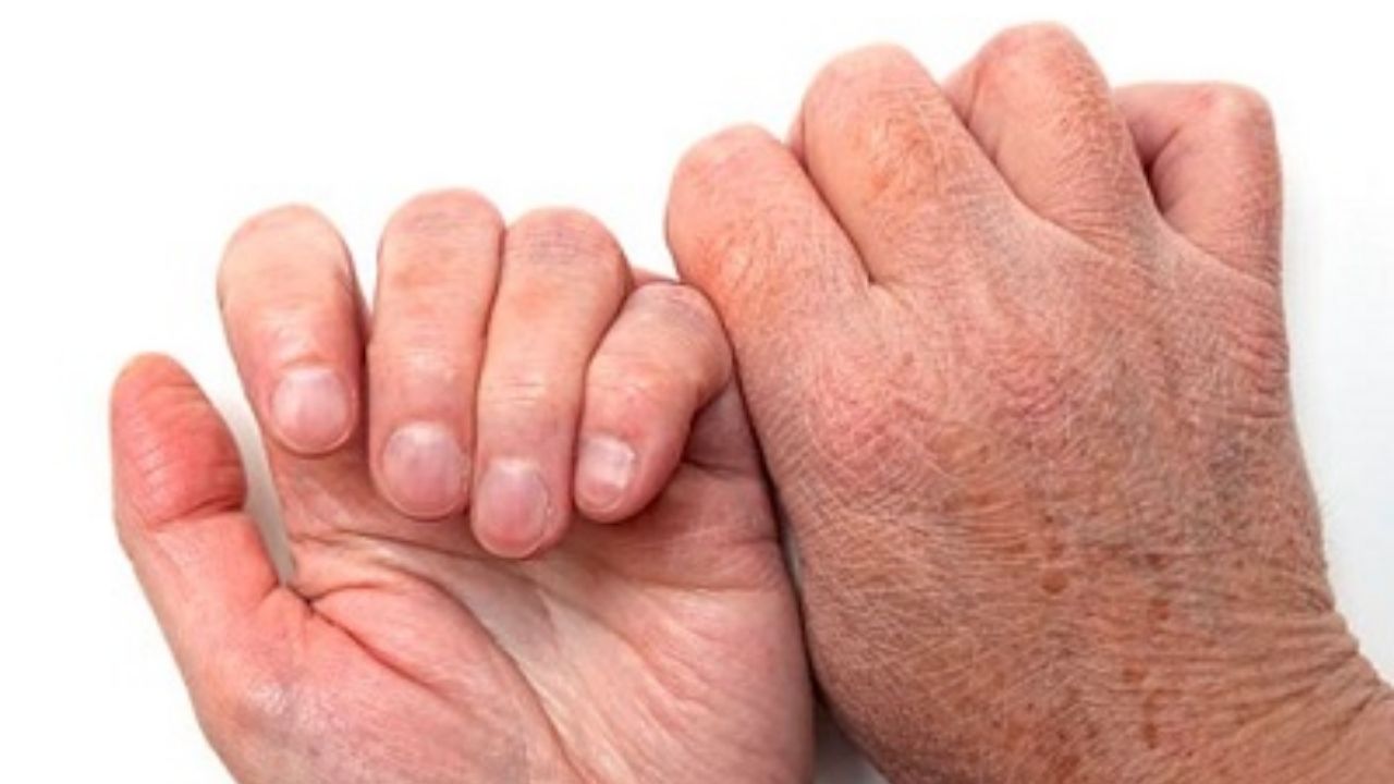 Kuru Ciltler Nedenleri, Belirtileri Ve Tedavi Yöntemleri - Yazar Kadın