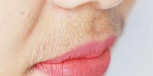 Hirsutizm Nedir? Kadınlarda Tüylenmenin Altındaki Nedenler