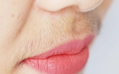 Hirsutizm Nedir? Kadınlarda Tüylenmenin Altındaki Nedenler