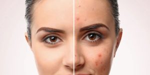 Hormonal Değişimlerin Cilt Üzerindeki Etkileri ve Bakım Önerileri