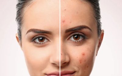 Hormonal Değişimlerin Cilt Üzerindeki Etkileri ve Bakım Önerileri