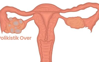 Polikistik Over Sendromu (PCOS) ve Adet Düzensizliği