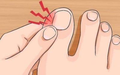 Gebelikte Tırnak Batması: Güvenli Müdahale Yöntemleri