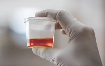 İdrardan Kan Gelmesi Kanser Belirtisi mi? Erken Teşhisin Önemi