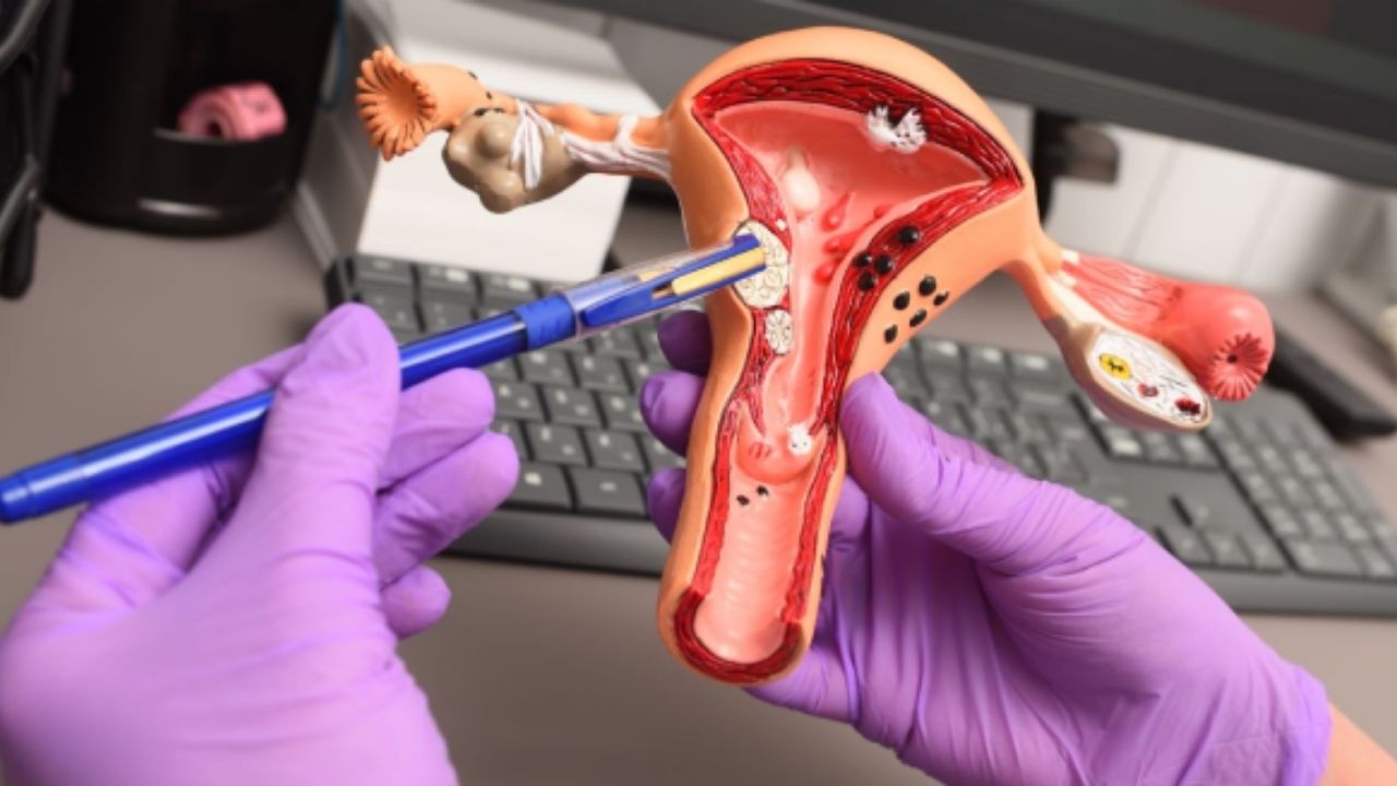 Rahim Kanseri Ile Yaşamak Tedavi Süreci Ve Psikolojik Destek - Yazar Kadın