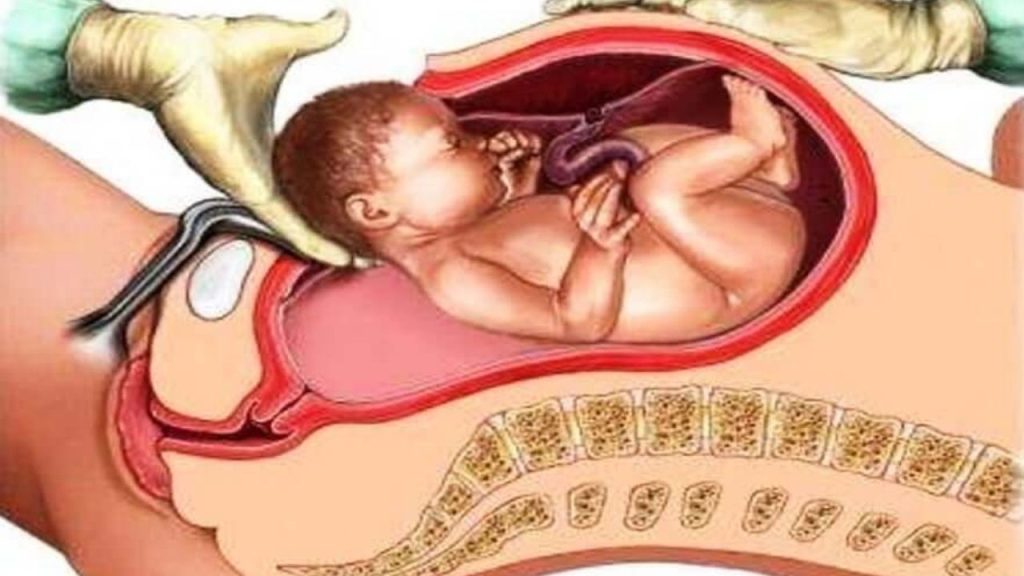 Sezaryen Doğum Nedir Hangi Durumlarda Tercih Edilir - Yazar Kadın
