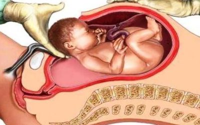 Sezaryen Doğum Nedir? Hangi Durumlarda Tercih Edilir?