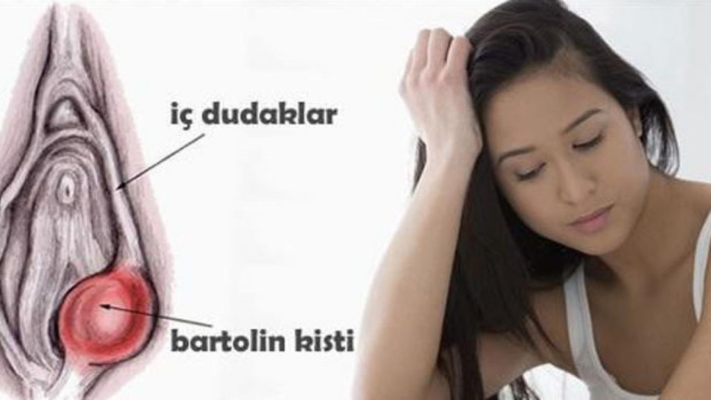 Bartholin Kisti Psikolojik Ve Cinsel Yaşamı Nasıl Etkiler - Yazar Kadın