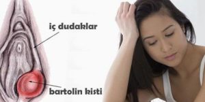 Bartholin Kisti Psikolojik ve Cinsel Yaşamı Nasıl Etkiler?