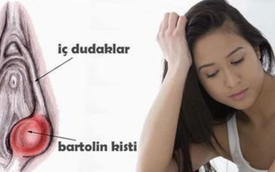 Bartholin Kisti Psikolojik ve Cinsel Yaşamı Nasıl Etkiler?