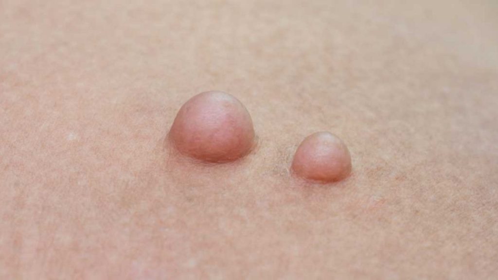 Genital Bölgede Oluşan Yağ Bezeleri Hakkında Merak Edilenler - Yazar Kadın
