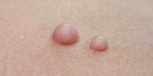 Genital Bölgede Oluşan Yağ Bezeleri Hakkında Merak Edilenler