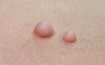 Genital Bölgede Oluşan Yağ Bezeleri Hakkında Merak Edilenler