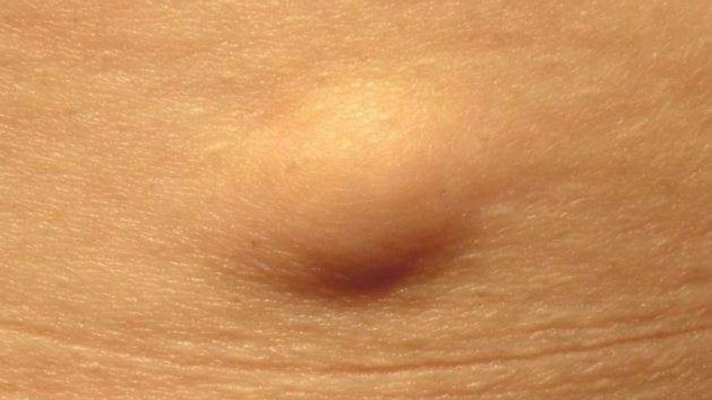 Genital Bölgede Yağ Bezesi Oluşumu Ne Zaman Endişelenmeli - Yazar Kadın