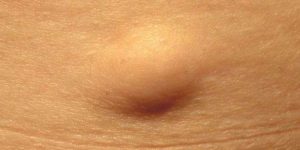 Genital Bölgede Yağ Bezesi Oluşumu