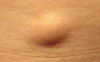 Genital Bölgede Yağ Bezesi Oluşumu