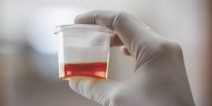 İdrarda Kan Görüldüğünde Ne Zaman Doktora Başvurulmalı?