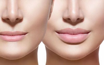 Dudak Kaldırma ile Daha Genç ve Dolgun Görünüm