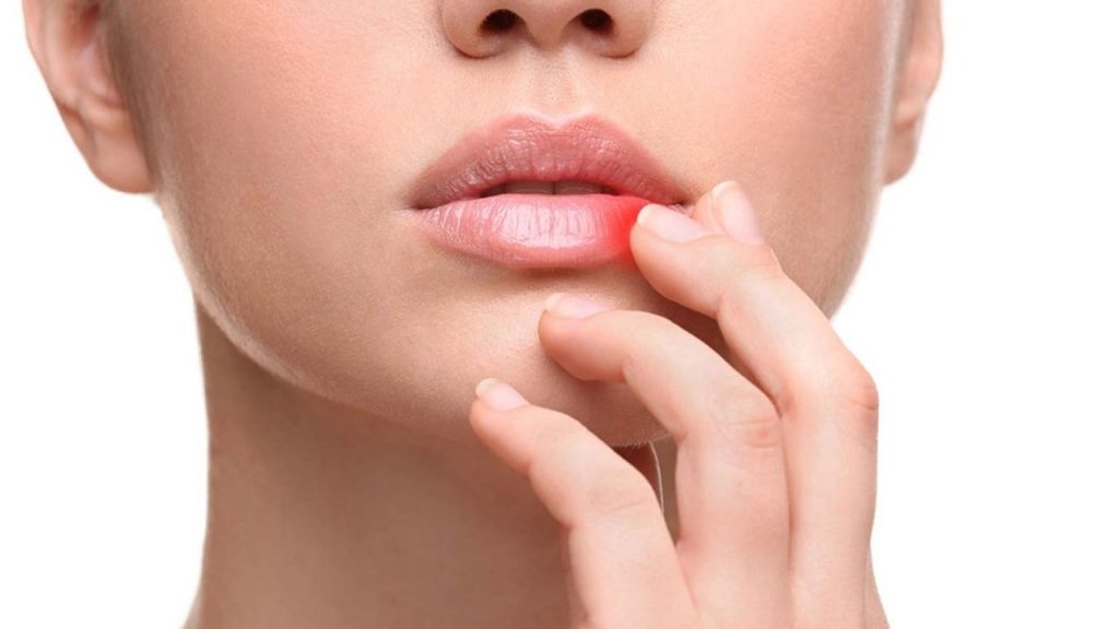 Dudak Kanseri Belirtiler, Nedenler, Risk Faktörleri Ve Korunma Yolları - Yazar Kadın