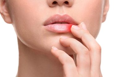 Dudak Kanseri: Belirtiler, Nedenler, Risk Faktörleri ve Korunma Yolları