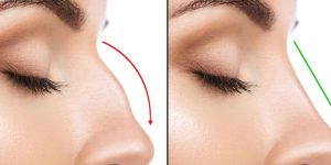 Estetik Burun Ameliyatı Hakkında Bilmeniz Gereken Her Şey