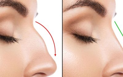 Estetik Burun Ameliyatı Hakkında Bilmeniz Gereken Her Şey