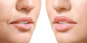 Kadınlarda Dudak Kaldırma İşlemi Öncesi ve Sonrası