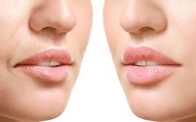 Kadınlarda Dudak Kaldırma İşlemi Öncesi ve Sonrası