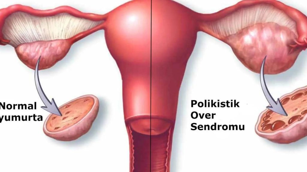 Polikistik Over Sendromu (pcos) Ve Adet Düzensizliği - Yazar Kadın