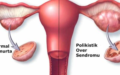 Polikistik Over Sendromu (PCOS) ve Adet Düzensizliği