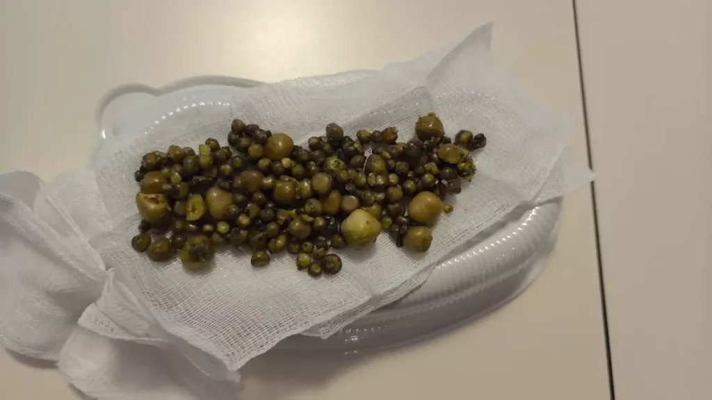 Bursa Da 77 Yasindaki Kadinin Safra Kesesinde 19232537 Amp - Yazar Kadın