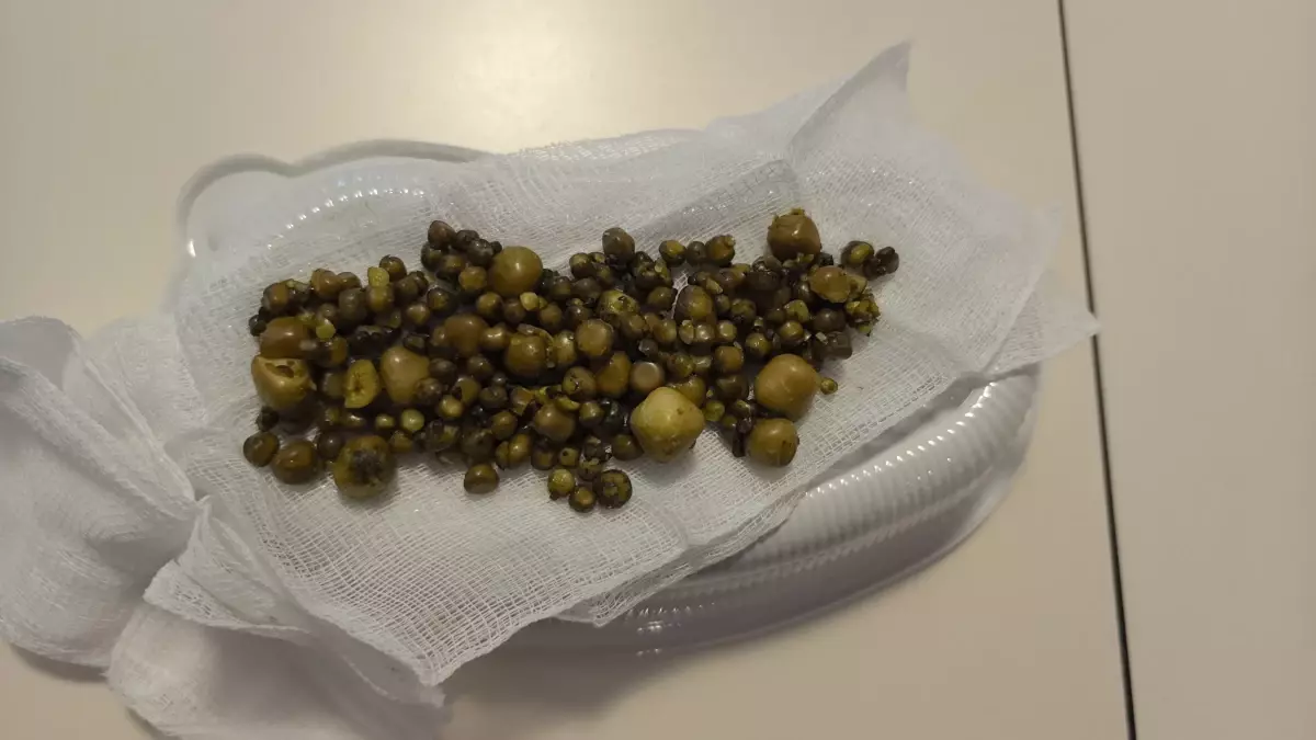 Bursa Da 77 Yasindaki Kadinin Safra Kesesinde 19232537 Amp - Yazar Kadın