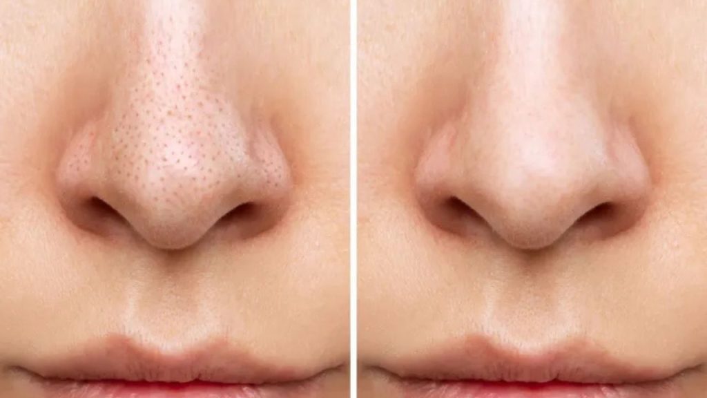 Burnunuzdaki Siyah Noktalara Müdahale Etmeyin! Dermatologlardan Kritik Uyarı Büyük Hata Yapıyorsunuz - Yazar Kadın