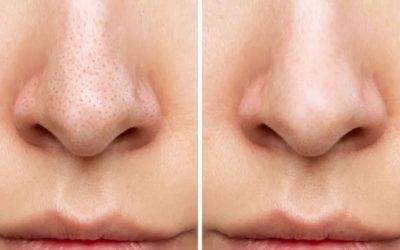 Burnunuzdaki Siyah Noktalara M&uuml;dahale Etmeyin! Dermatologlardan Kritik Uyarı: &ldquo;B&uuml;y&uuml;k Hata Yapıyorsunuz&rdquo;